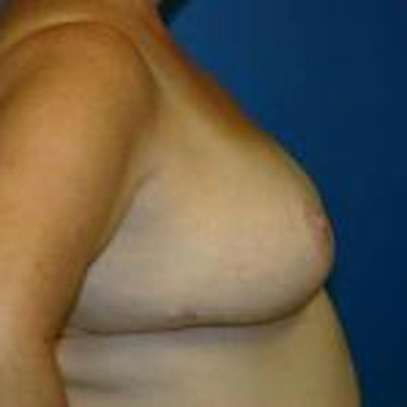 Breast Reduction Before & After Gallery - Patient 358591 - Image 4