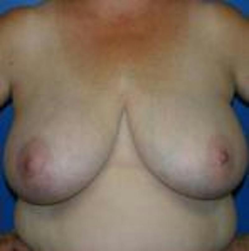 Breast Reduction Before & After Gallery - Patient 358591 - Image 1
