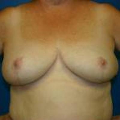 Breast Reduction Before & After Gallery - Patient 358591 - Image 2