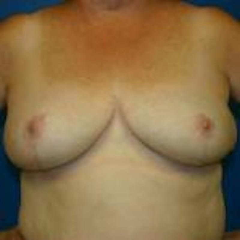 Breast Reduction Before & After Gallery - Patient 358591 - Image 2
