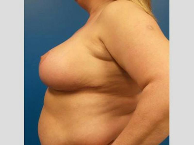 Breast Reduction Before & After Gallery - Patient 365003 - Image 6