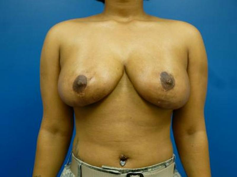 Breast Reduction Before & After Gallery - Patient 107391 - Image 2