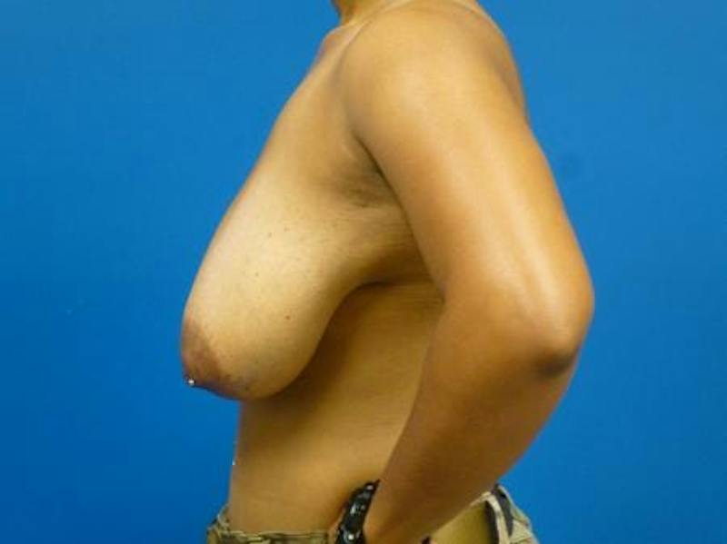 Breast Reduction Before & After Gallery - Patient 107391 - Image 5