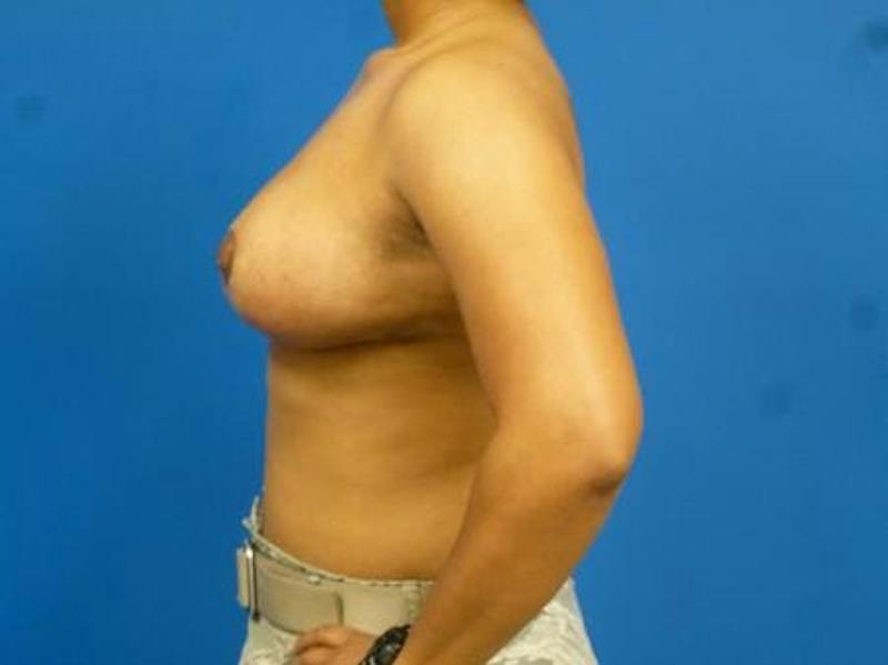 Breast Reduction Before & After Gallery - Patient 107391 - Image 6