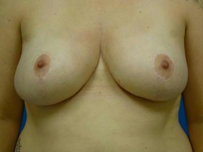 Breast Reduction Before & After Gallery - Patient 175865 - Image 2