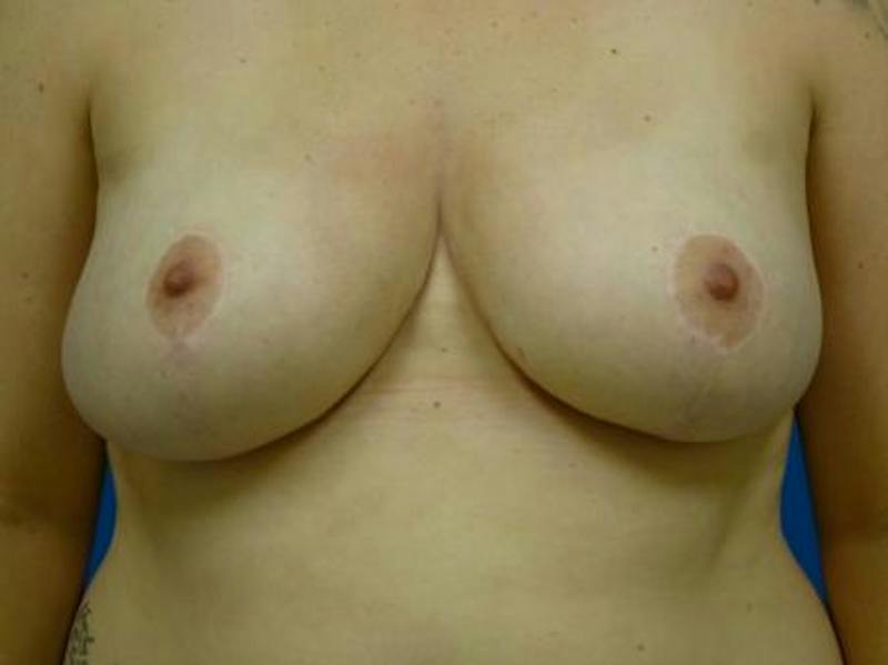 Breast Reduction Before & After Gallery - Patient 175865 - Image 2