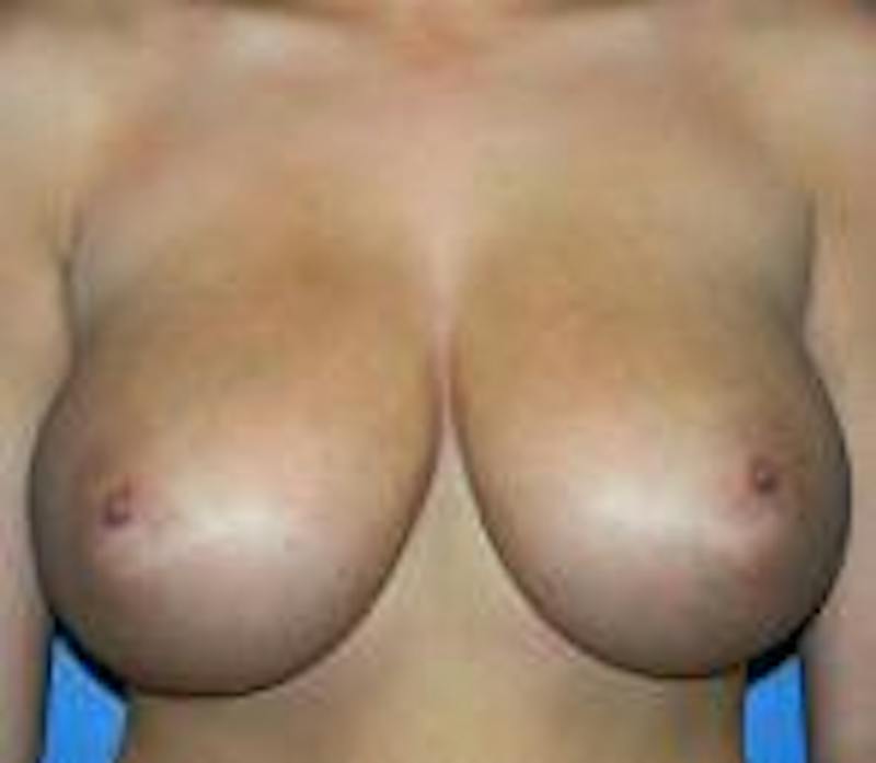 Breast Reduction Before & After Gallery - Patient 926283 - Image 1