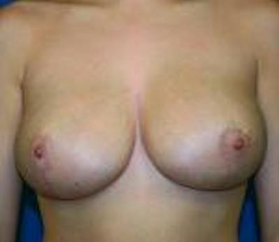 Breast Reduction Before & After Gallery - Patient 926283 - Image 2