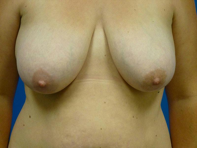 Breast Reduction Before & After Gallery - Patient 103614 - Image 1