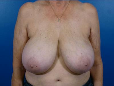 Breast Reduction Before & After Gallery - Patient 170008 - Image 1