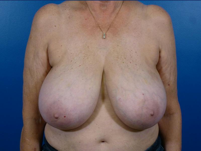 Breast Reduction Before & After Gallery - Patient 170008 - Image 1