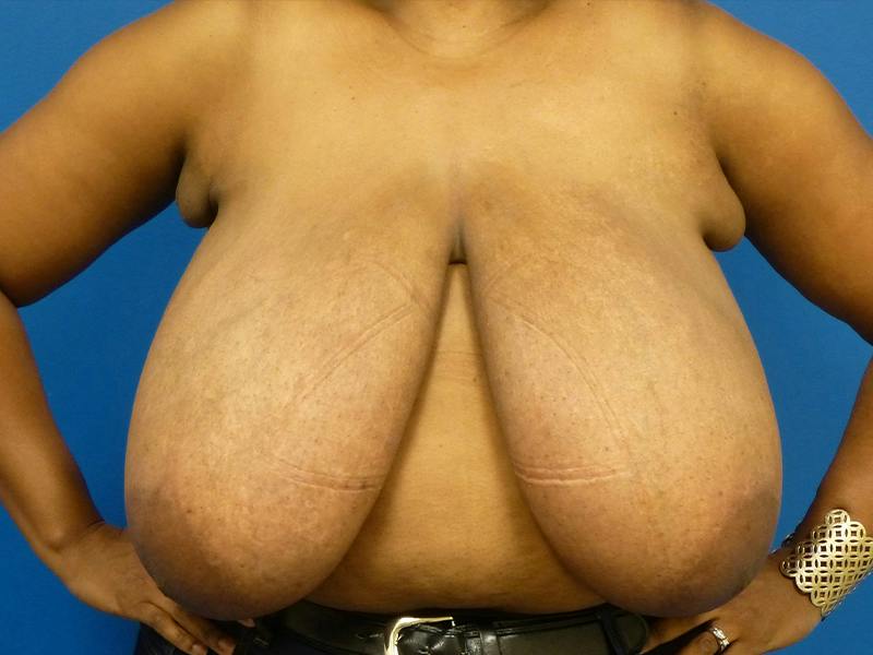 Breast Reduction Before & After Gallery - Patient 696441 - Image 1
