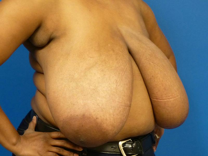 Breast Reduction Before & After Gallery - Patient 696441 - Image 3
