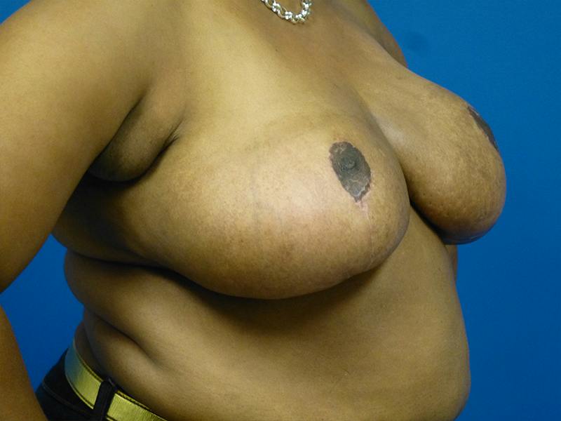 Breast Reduction Before & After Gallery - Patient 696441 - Image 4