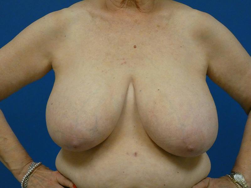 Breast Reduction Before & After Gallery - Patient 425972 - Image 1