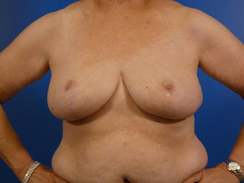 Breast Reduction Before & After Gallery - Patient 425972 - Image 2