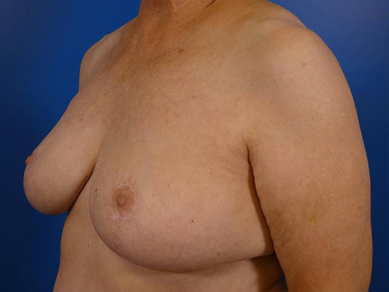 Breast Reduction Before & After Gallery - Patient 425972 - Image 4