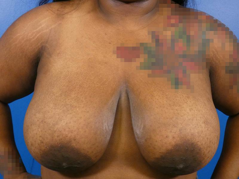 Breast Reduction Before & After Gallery - Patient 344295 - Image 1
