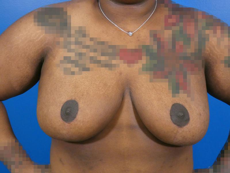 Breast Reduction Before & After Gallery - Patient 344295 - Image 2