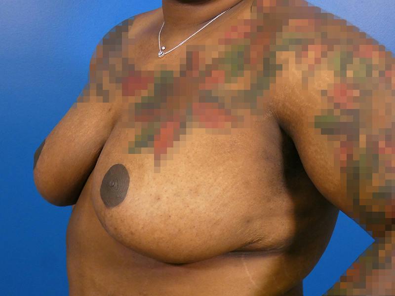 Breast Reduction Before & After Gallery - Patient 344295 - Image 4