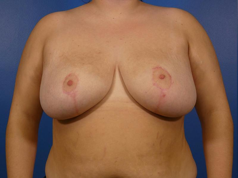 Breast Reduction Before & After Gallery - Patient 421401 - Image 2