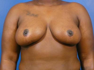 Breast Reduction Before & After Gallery - Patient 374755 - Image 2