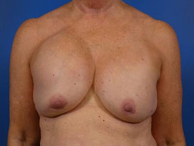 Breast Revision Before & After Gallery - Patient 259659 - Image 1