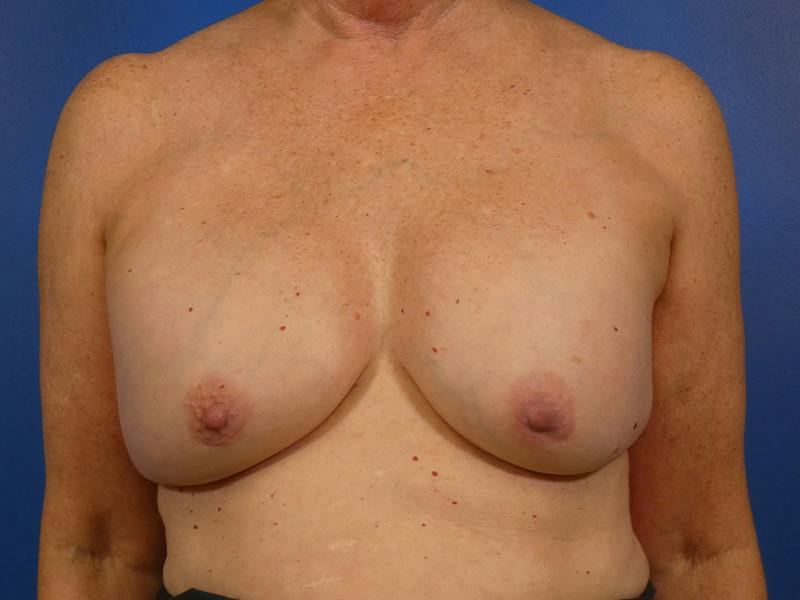 Breast Revision Before & After Gallery - Patient 259659 - Image 2