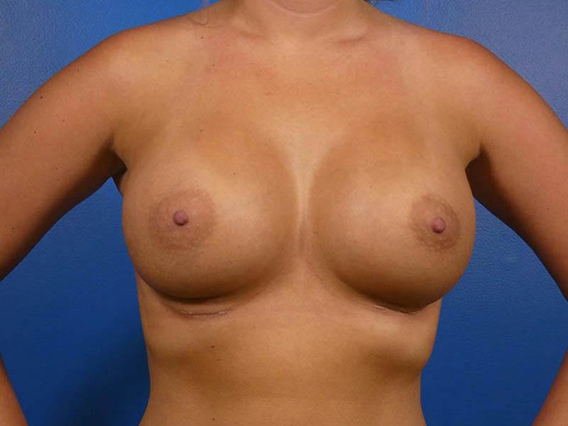 Breast Revision Before & After Gallery - Patient 889356 - Image 2