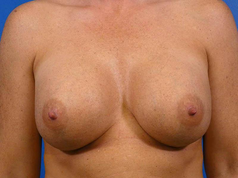 Breast Revision Before & After Gallery - Patient 329846 - Image 2