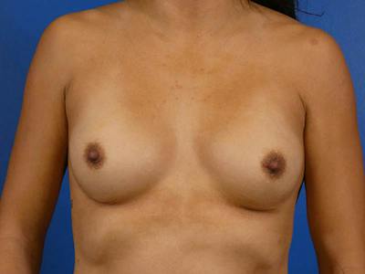 Breast Revision Before & After Gallery - Patient 278684 - Image 1