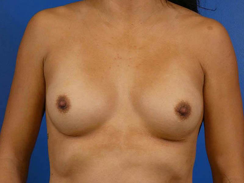 Breast Revision Before & After Gallery - Patient 278684 - Image 1