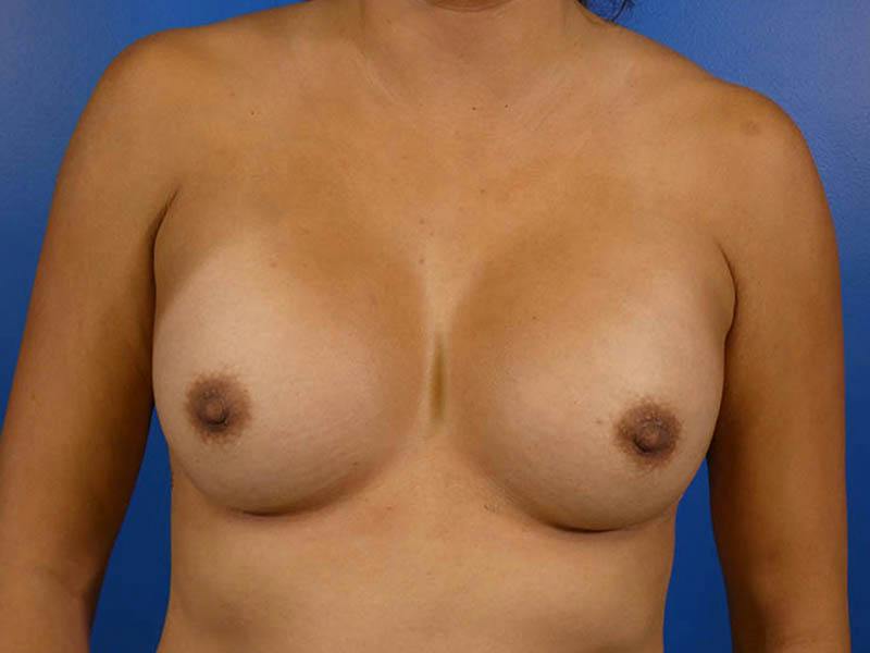Breast Revision Before & After Gallery - Patient 278684 - Image 2