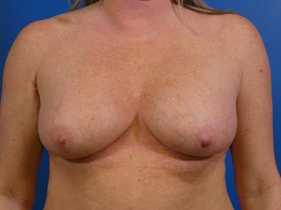 Breast Revision Before & After Gallery - Patient 145910 - Image 1
