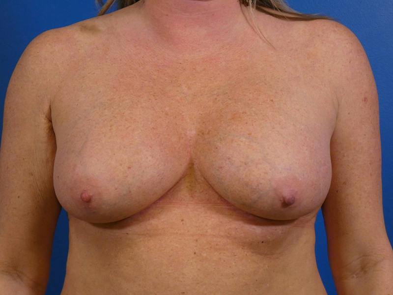 Breast Revision Before & After Gallery - Patient 145910 - Image 1