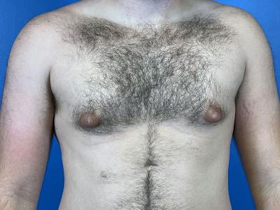 Gynecomastia Before & After Gallery - Patient 426529 - Image 1