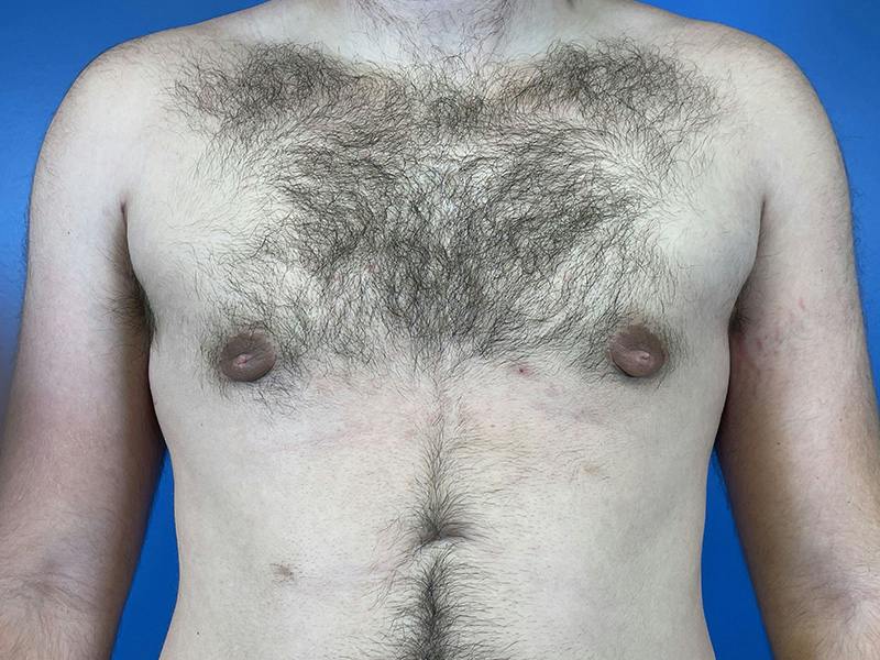 Gynecomastia Before & After Gallery - Patient 426529 - Image 2