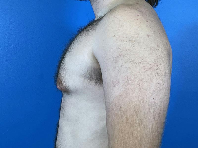 Gynecomastia Before & After Gallery - Patient 426529 - Image 3