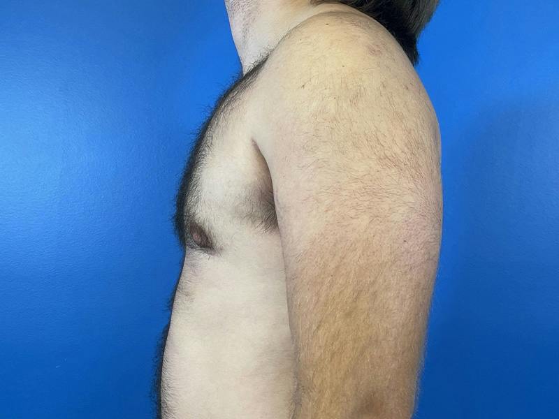Gynecomastia Before & After Gallery - Patient 426529 - Image 4