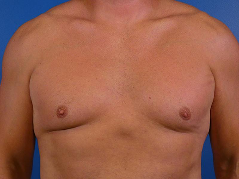 Gynecomastia Before & After Gallery - Patient 248453 - Image 1