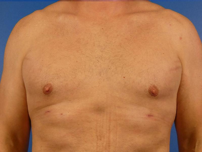 Gynecomastia Before & After Gallery - Patient 248453 - Image 2