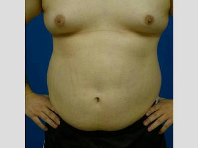 Gynecomastia Before & After Gallery - Patient 215239 - Image 1