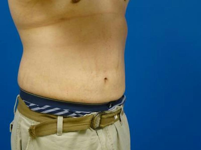 Liposuction Before & After Gallery - Patient 188733 - Image 2