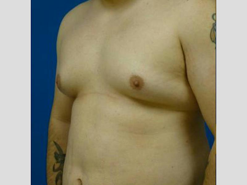 Liposuction Before & After Gallery - Patient 188733 - Image 3