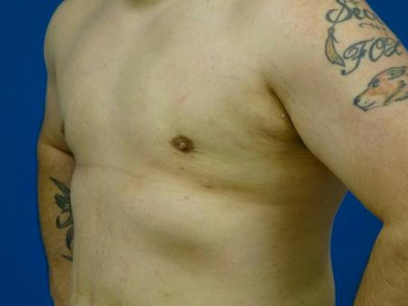 Liposuction Before & After Gallery - Patient 188733 - Image 4