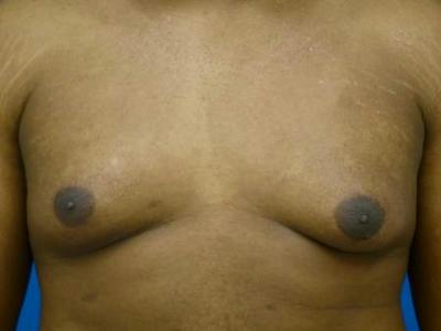 Gynecomastia Before & After Gallery - Patient 223897 - Image 1