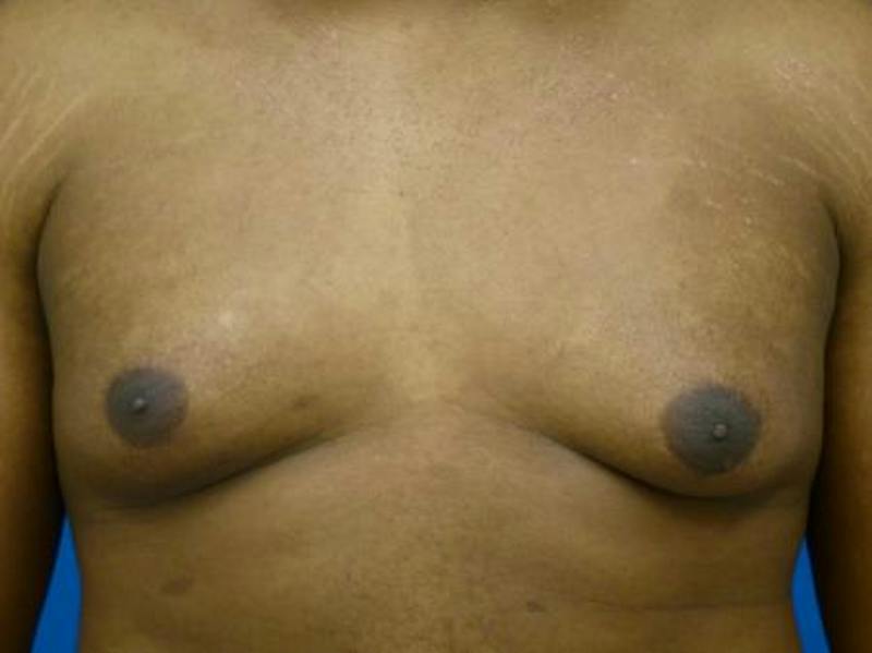Gynecomastia Before & After Gallery - Patient 223897 - Image 1