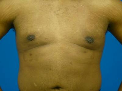 Gynecomastia Before & After Gallery - Patient 223897 - Image 2