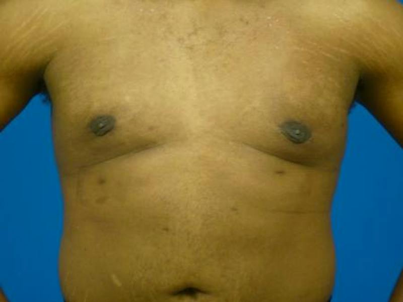 Gynecomastia Before & After Gallery - Patient 223897 - Image 2