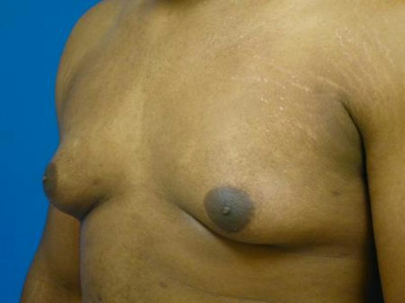 Gynecomastia Before & After Gallery - Patient 223897 - Image 3